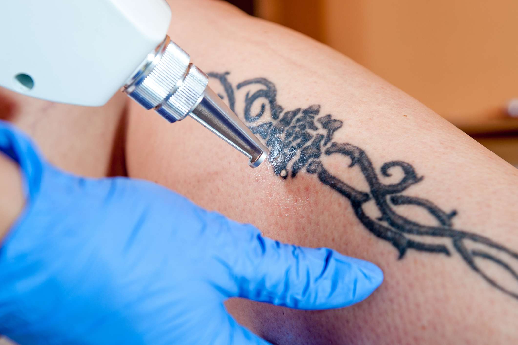 Would you like to remove your tattoo? 4 techniques that help
