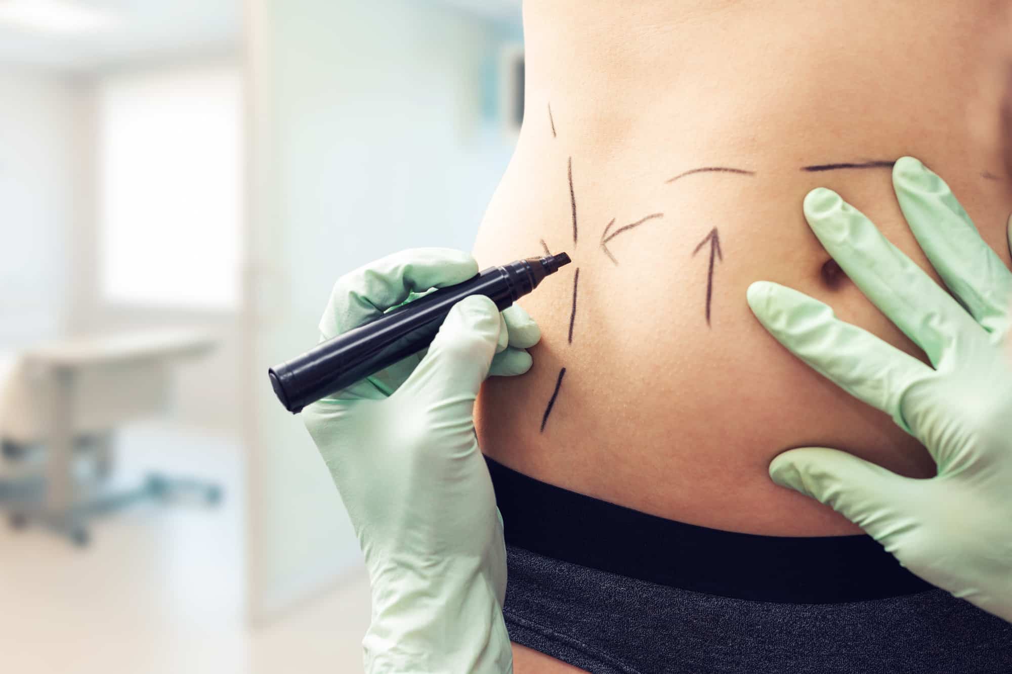 How Much Does a Tummy Tuck Cost? The Prices Explained