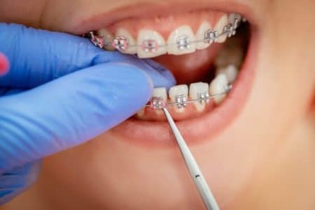 4 Different Types of Orthodontics