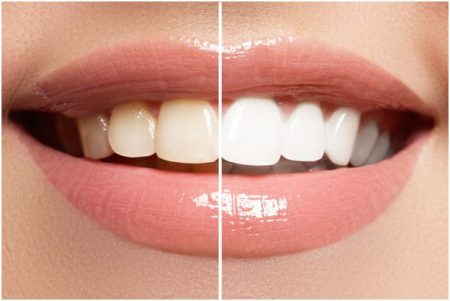 Smile With Confidence: 5 Amazing Benefits of a Professional Teeth Whitening Treatment