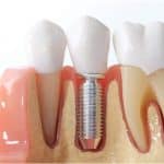 Debunking the Most Common and Best Dental Implant Myths