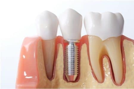 Debunking the Most Common and Best Dental Implant Myths