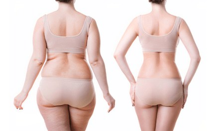 Ultimate Guide to Body Lift Surgery Ultimate Guide to Body Lift Surgery